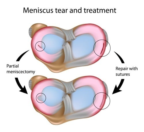 Torn cartilage outlet